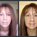 2006 - Left) Before Lip Lift...Right) Two days after Lip Lift w/ stitches...Very Swollen.