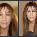 2006 - Left) Two weeks after Lip Lift...Right) Two months after Lip Lift
