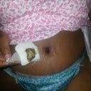 3 days post op. Excuse the nasty dressing. I love how my bb looks