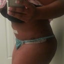 Post op day 3. Left side. Swollen but looks great