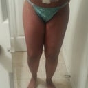 Post op day 3 front view. Swollen but beautiful! I'm a happy camper!