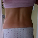 5 years post op
