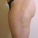 After - left side