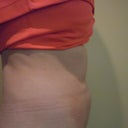 Day after procedure