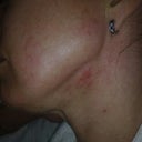 10 days after the treatment.