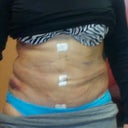 Morning after surgery it's lumpy because of the CG