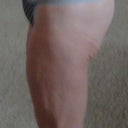 9 weeks post op, side view.