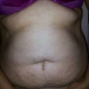Gained 14 lbs just before surgery in order to take out as much as possible