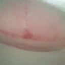 this is the "spot" under my left breast that is only now clearing up...grr!