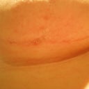 healing a bit better under right breast