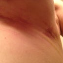 Left scar 2 weeks