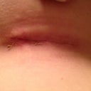Right scar 2 weeks