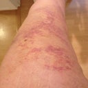 Day 7 - side of one leg