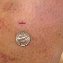 Day 7 - size of the incision next to a dime