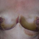 post op 12 days