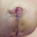 deep bruising and bleeding despite drains