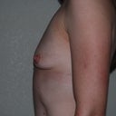 8 months post explant. I am very happy with them.