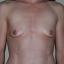 8 months post explant.