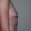 8 months post explant.