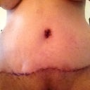 8 days post op