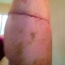 8 days post op, flat butt but that will improve later