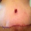 8 days post op