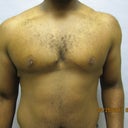 34 Y.o Man With Breast Reduction