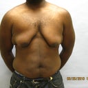 34 Y.o Man With Breast Reduction