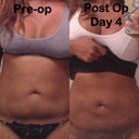 4 dys post surgery . Continuing massages, ice and walking daily