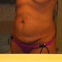 my right breast had begun to sag over the implant, also causing my right nipple to stretch and no longer be circular