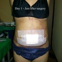 Day 1 - just after surgery. Tummy and hips are swollen. Bruises all over bodies till beneath tummy area.