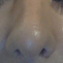 this is now my nose from the front - two months on it is still very swollen on the tip but it is dead straight :)