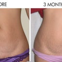 beforeafterbelly.jpg