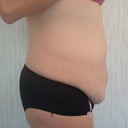 side view before.I will be glad when there isnt anymore skin to roll my underwear down anymore