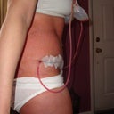 2 days post op