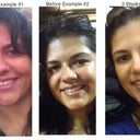 Some comparison. The first two left pictures are examples of previous nose. The far right is at 3 weeks (2 days after steroid shot)