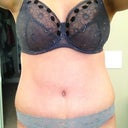 6 weeks PO in my 34F beautiful bra, and low cut undies that hide the scar well. If anything, the scar may be a bit low, you can see it poking out on the right side.