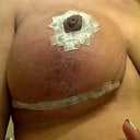 This was about a week after surgery, I had internal dissolving sutures and steri-strips on the outside. The black lines are my stitches.