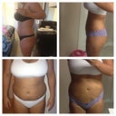 6 days upper/lower before and after