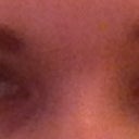 2 weeks post op with a little make-up on lashes