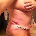 Right After Surgery