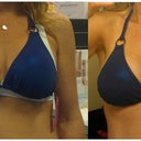 Ok, here's the blue bikini shots side by side for comparison purposes. In the photo on the left I am wearing a 350 sizer on my right breast, and a 375 (they didn't have 380 in the office) on my left.