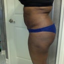 Pre-op side view