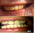 This is the before and after.  The after picture was taken with a phone.  So it really does no justice to my whiter smile.  But, it does show just how wonderful Zoom actually is!