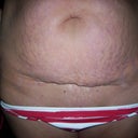 10-31-11 before surgery ~ C-Section Cut
