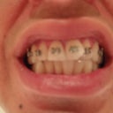 Unfinished braces