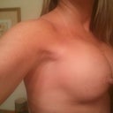 18 days post op side view w/ Ultra high profile. Slowly dropping but the projection is huge and looks awesome. NO ARM PIT BOOBIES love this photo.