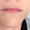 Before Juvederm injections in upper lip.