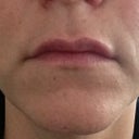 After Juvederm in upper lip.
