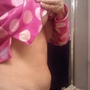10 wks this is the muscle protrduing out which needs to be revised in the fall.  im so bummed out now.  mr repair is great but this isnt